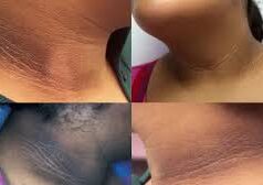 गर्दन का कालापन दूर करने के लिए रामबाण हैं ये 5 देसी नुस्खे, आज ही आजमाएं